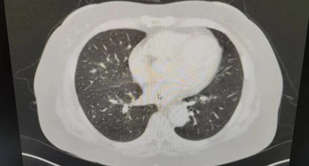 Pre-operative high-resolution CT scan showing the right lower lung nodule