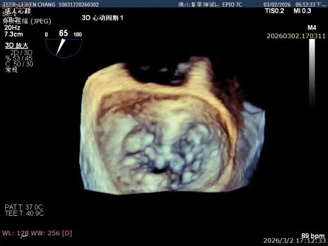 X-plane transesophageal echocardiography showing mitral valve prolapse before the procedure