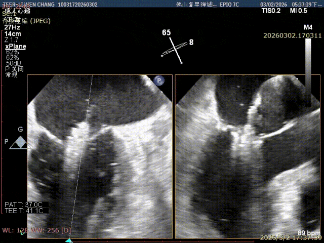 X-plane echo view of leaflet capture by the mitral clip
