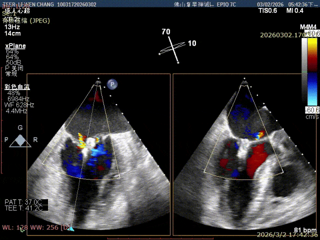 3D echo view of the clip opened beneath the mitral valve