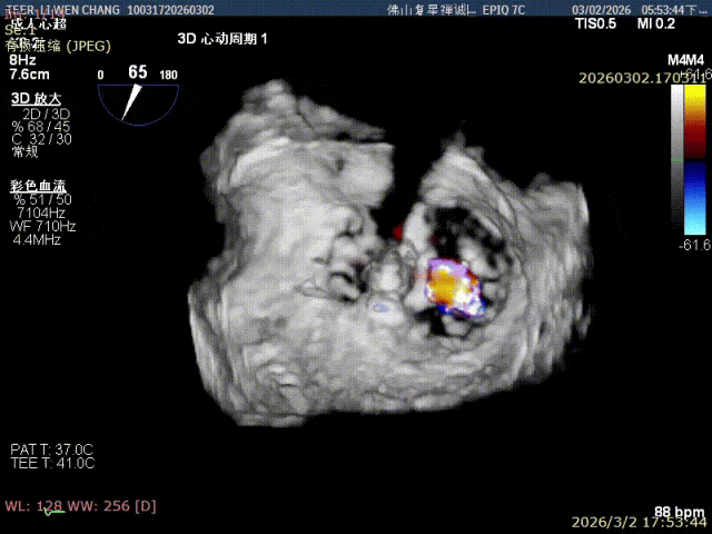 Color Doppler X-plane imaging after the second clip showing resolved regurgitation