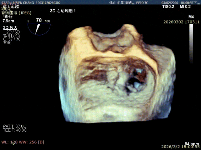 Final 3D en-face echo view of the double-orifice mitral valve after dual-clip TEER